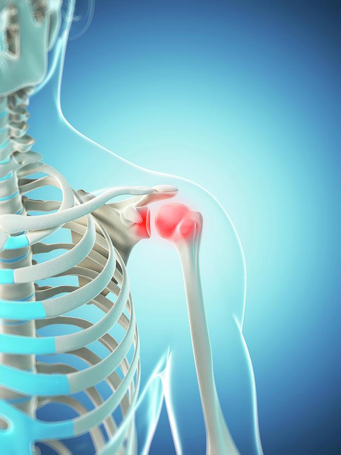 Shoulder Pain Photograph by Sciepro/science Photo Library - Pixels