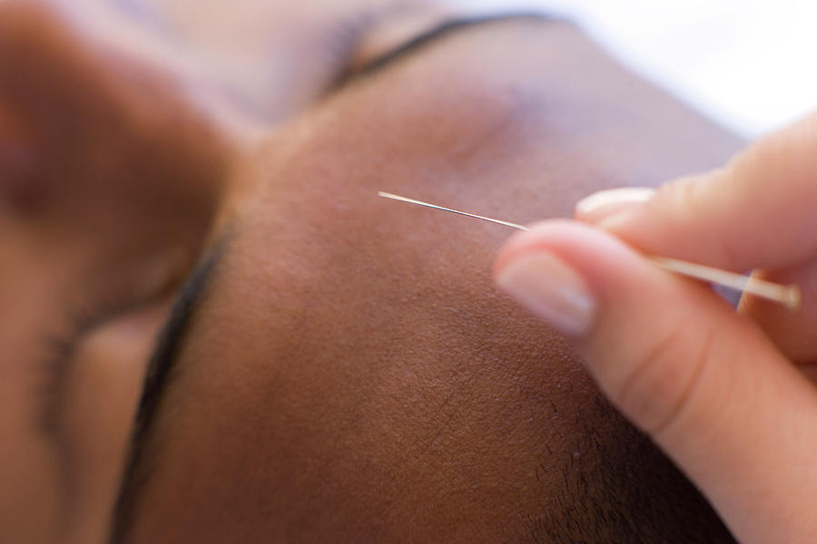 Acupuncture #2 Photograph by Ian Hooton/science Photo Library
