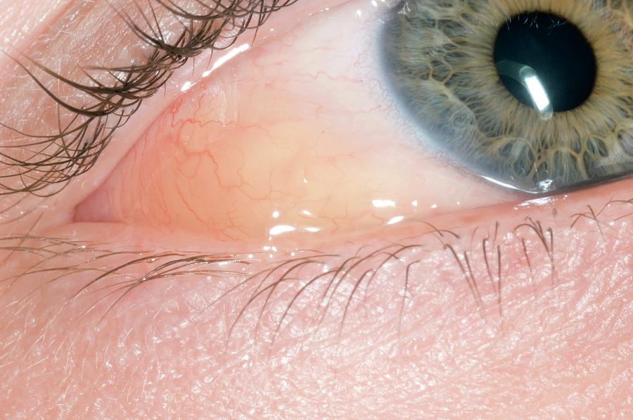 Allergic Conjunctivitis And Oedema Photograph By Dr P Marazziscience Photo Library 