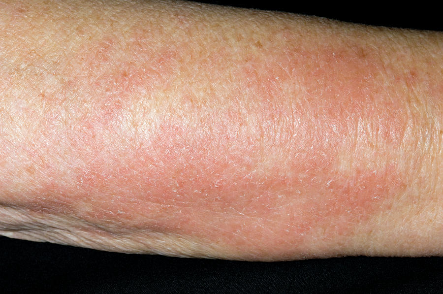 allergic-rash-photograph-by-dr-p-marazzi-science-photo-library