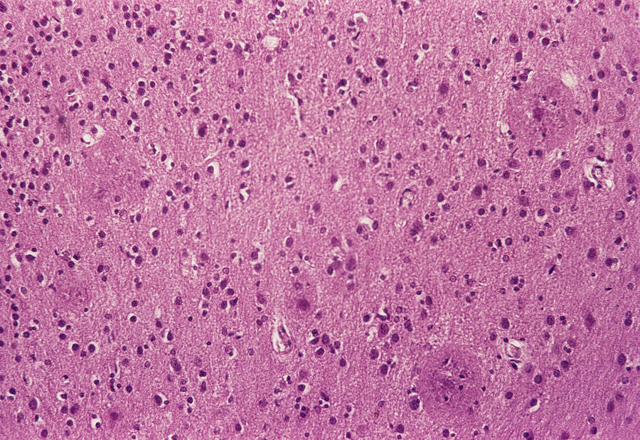 Alzheimers Disease Brain Tissue #2 Photograph by Cnri/science Photo Library