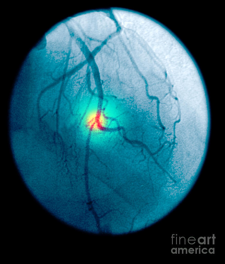 Angiogram Of A Blocked Coronary Artery #2 Photograph by Scott Camazine