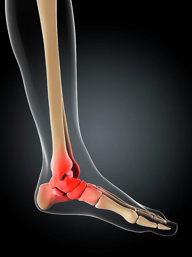 Ankle Pain #2 Photograph by Sciepro/science Photo Library