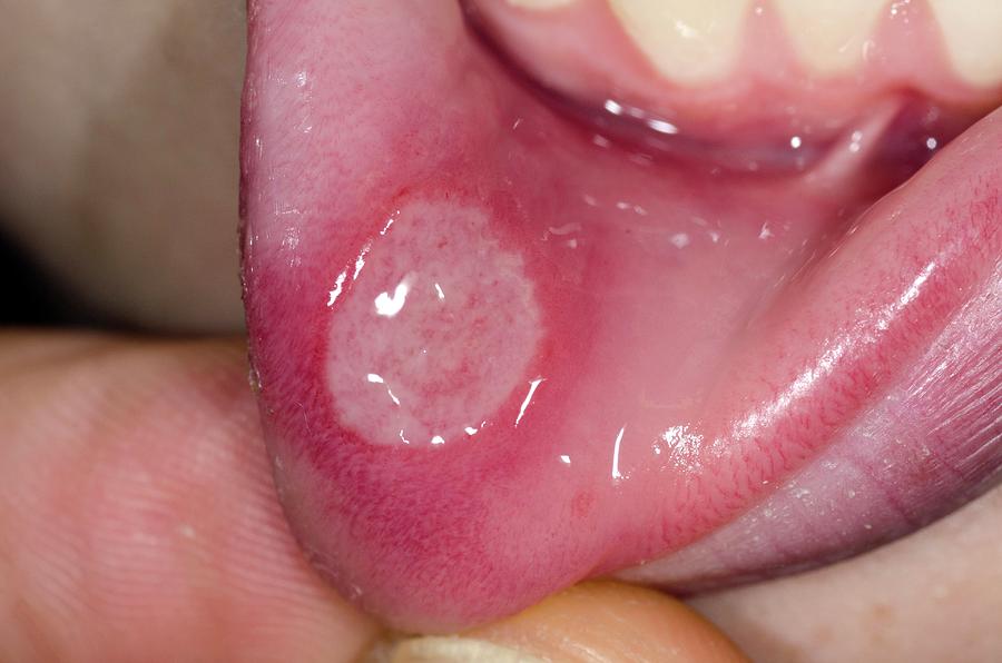 Aphthous Ulcer Of The Tongue Photograph By Dr P Marazzi Science Photo My XXX Hot Girl