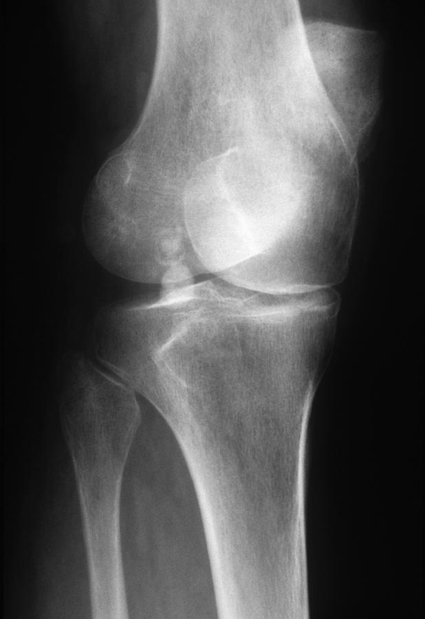 Arthritic Knee, X-ray Photograph by Chris Bjornberg