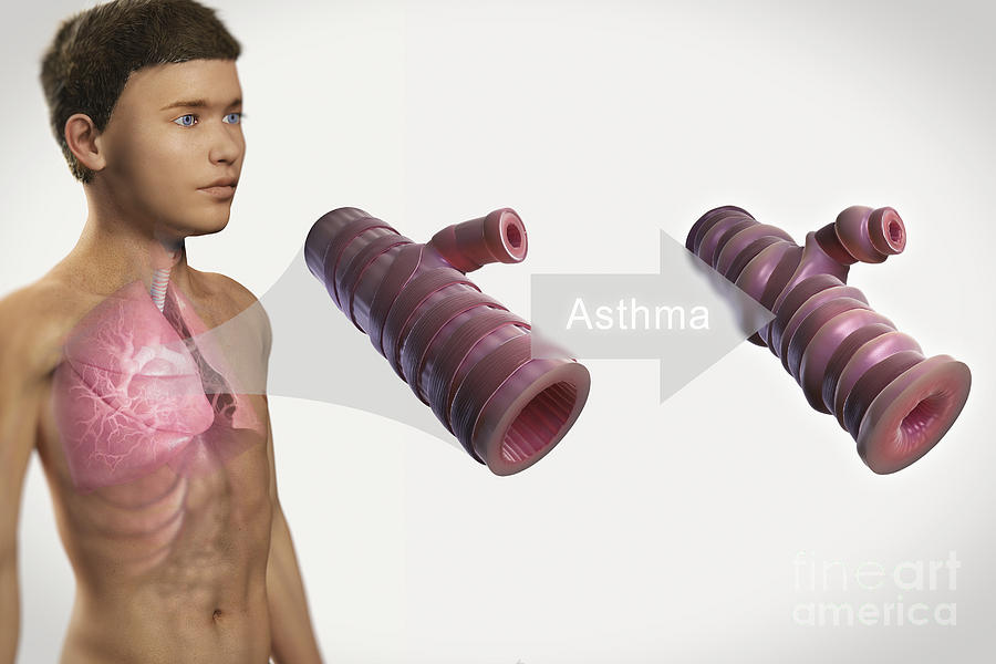 Paediatric Photograph - Asthmatic Airway #2 by Science Picture Co