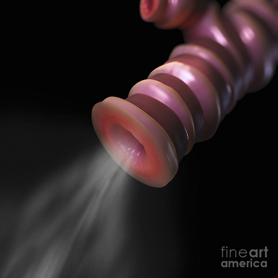 Asthma Photograph - Asthmatic Bronchiole #2 by Science Picture Co