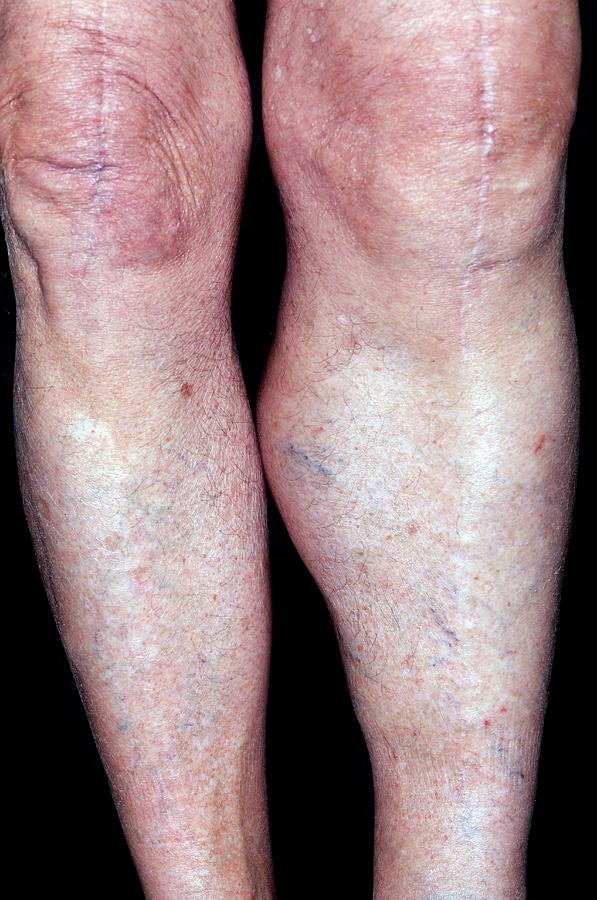 Bakers Cyst On The Leg Photograph By Dr P Marazziscience Photo Library