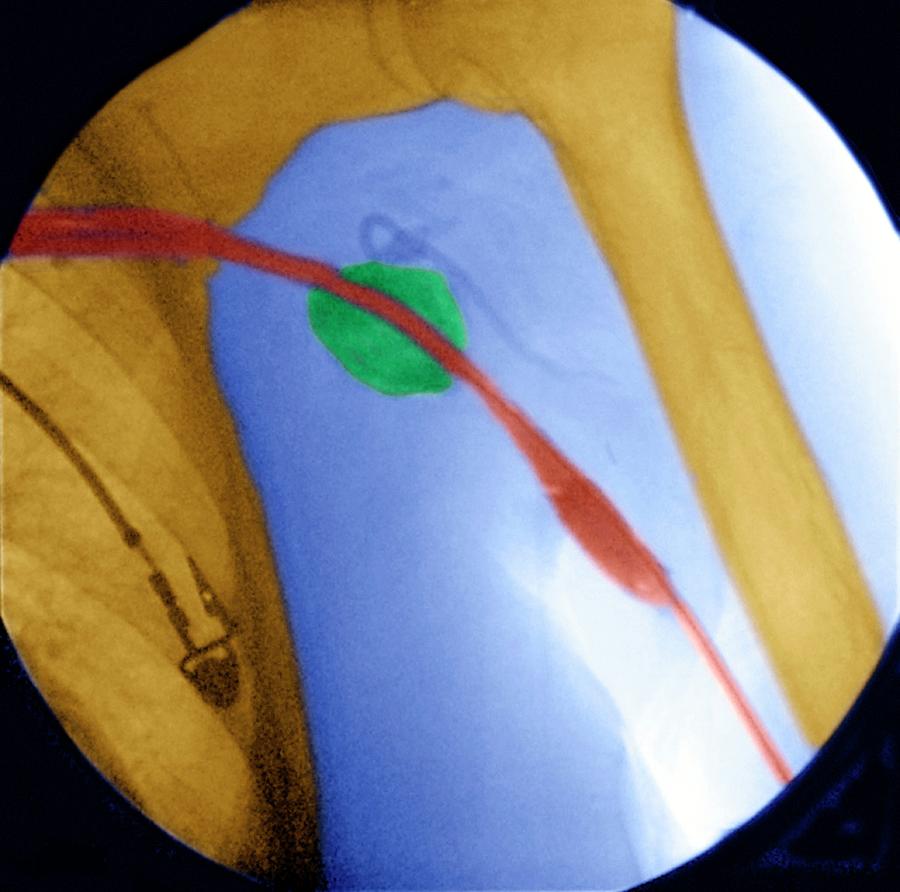 Blood Flow Photograph - Balloon Angioplasty by Aj Photo/science Photo Library Blood Flow Photograph - Balloon Angioplasty by Aj Photo/science Photo Library