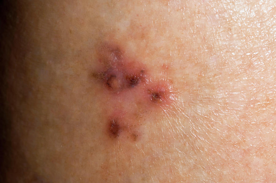 Basal Cell Carcinoma Photograph By Dr P Marazzi Science Photo Library