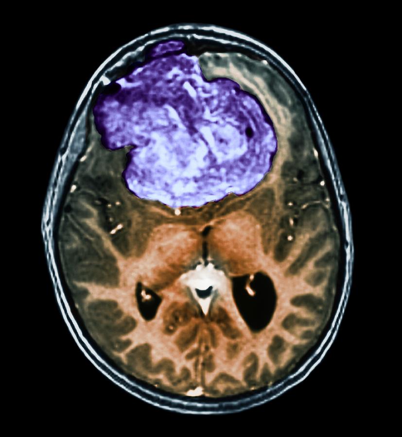 Benign Brain Tumour #2 Photograph by Zephyr