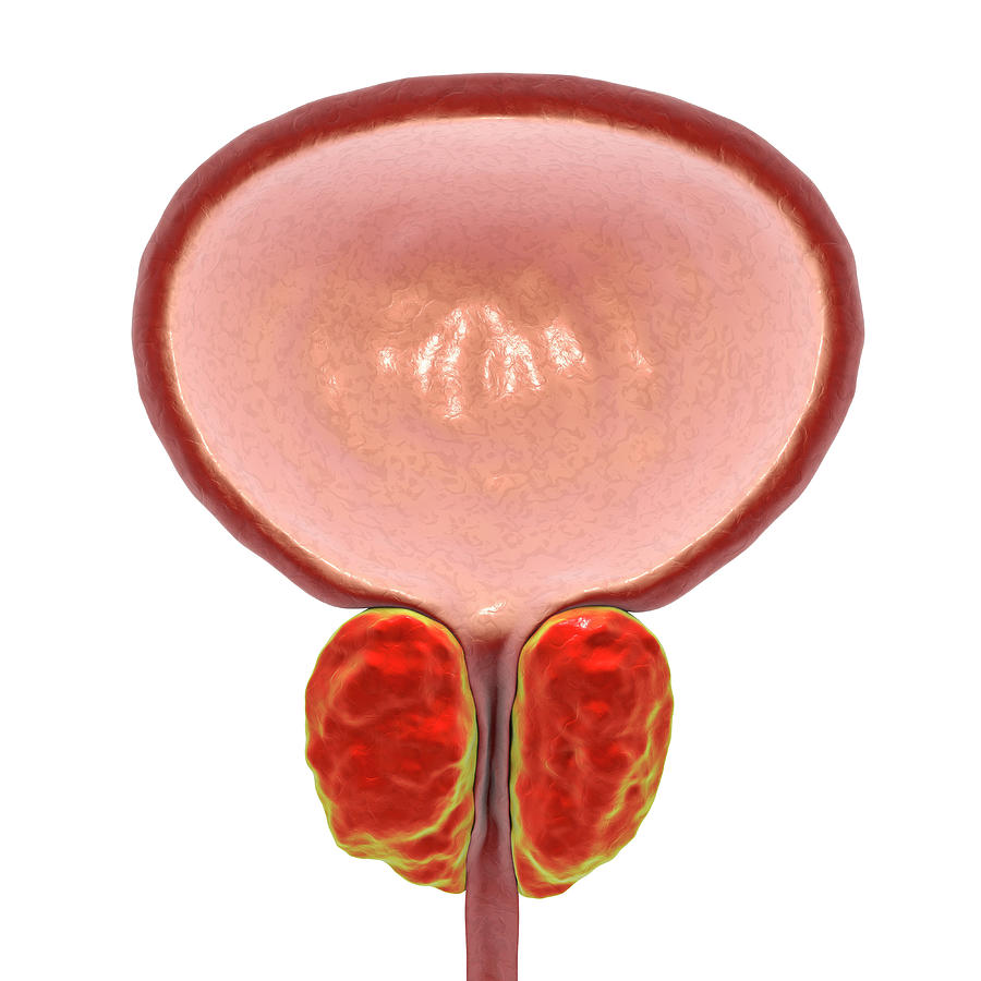 Benign Prostatic Hyperplasia Bph Medicolearning - vrogue.co