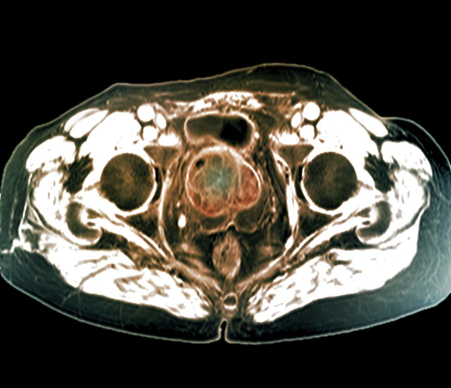 Benign Prostatic Hyperplasia Photograph by Zephyr