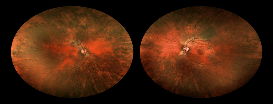 Bilateral Melanosis Of Eye #2 Photograph by Paul Whitten