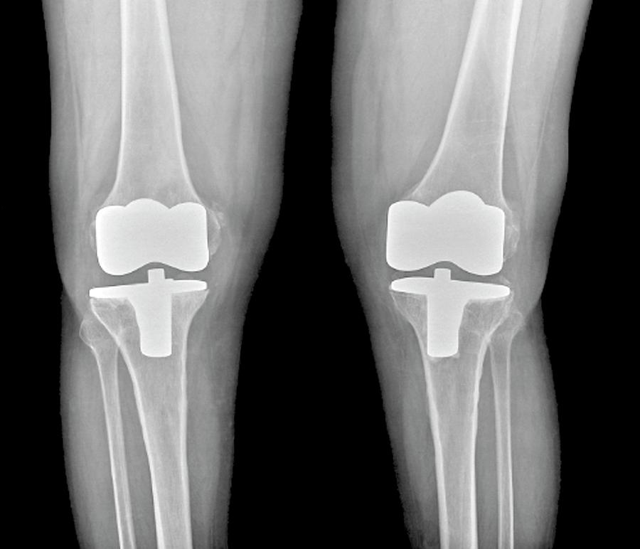 Bilateral Total Knee Replacement Photograph by Zephyr