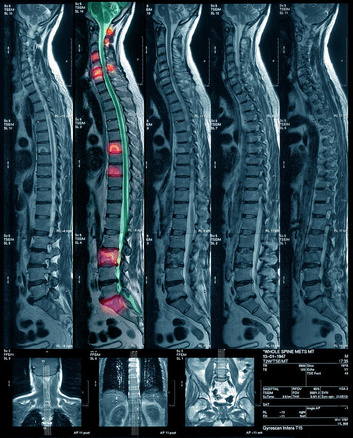 Bone Cancer Photograph By Simon Fraser/newcastle Hospitals Nhs Trust ...