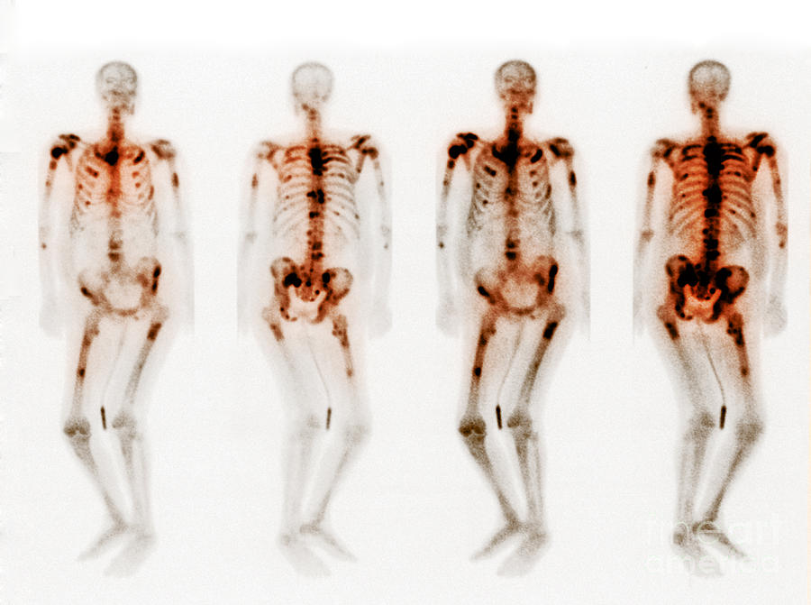 Bone Scan Showing Multiple Metastases #2 Photograph by Scott Camazine
