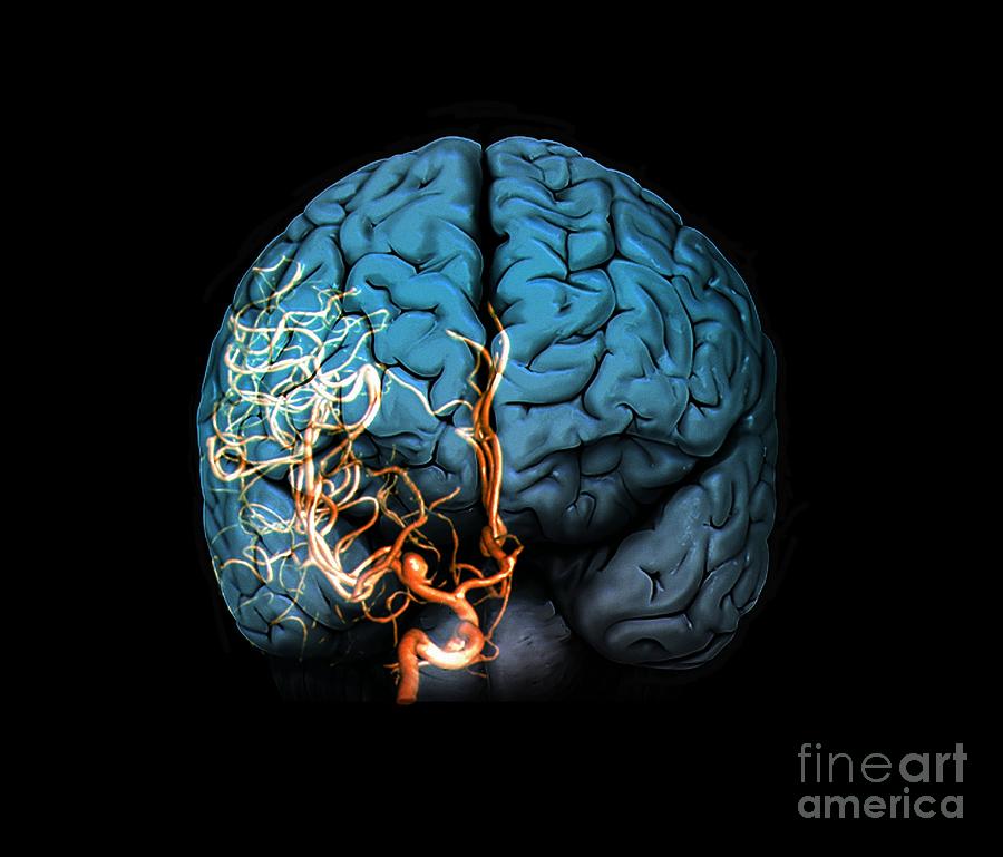 Brain Aneurysm, 3d Scan #2 by Science Photo Library