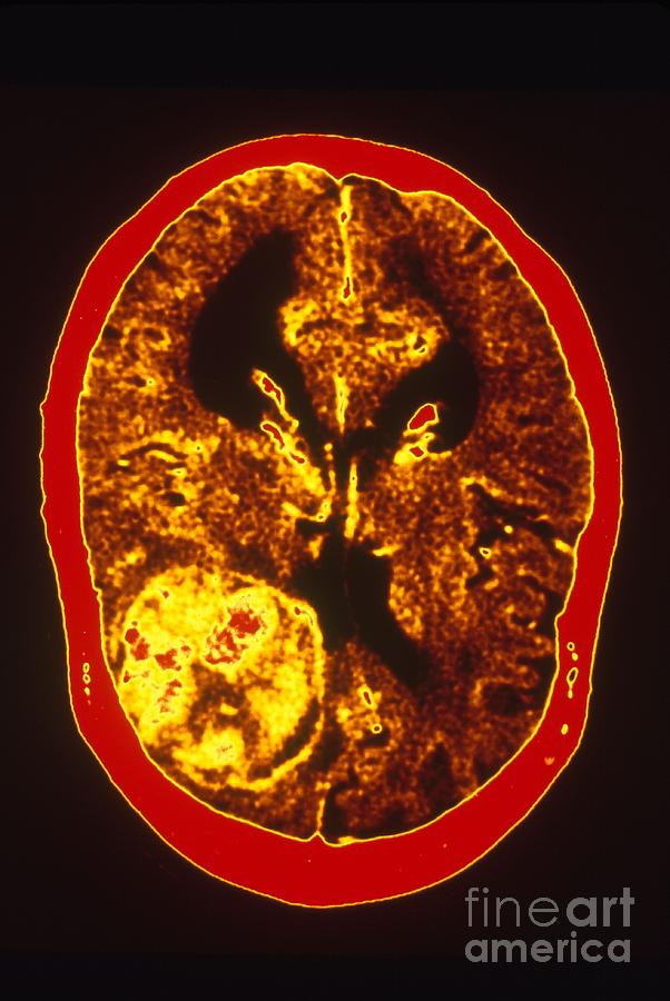 Brain Cancer Ct Scan Photograph By Scott Camazine Pixels