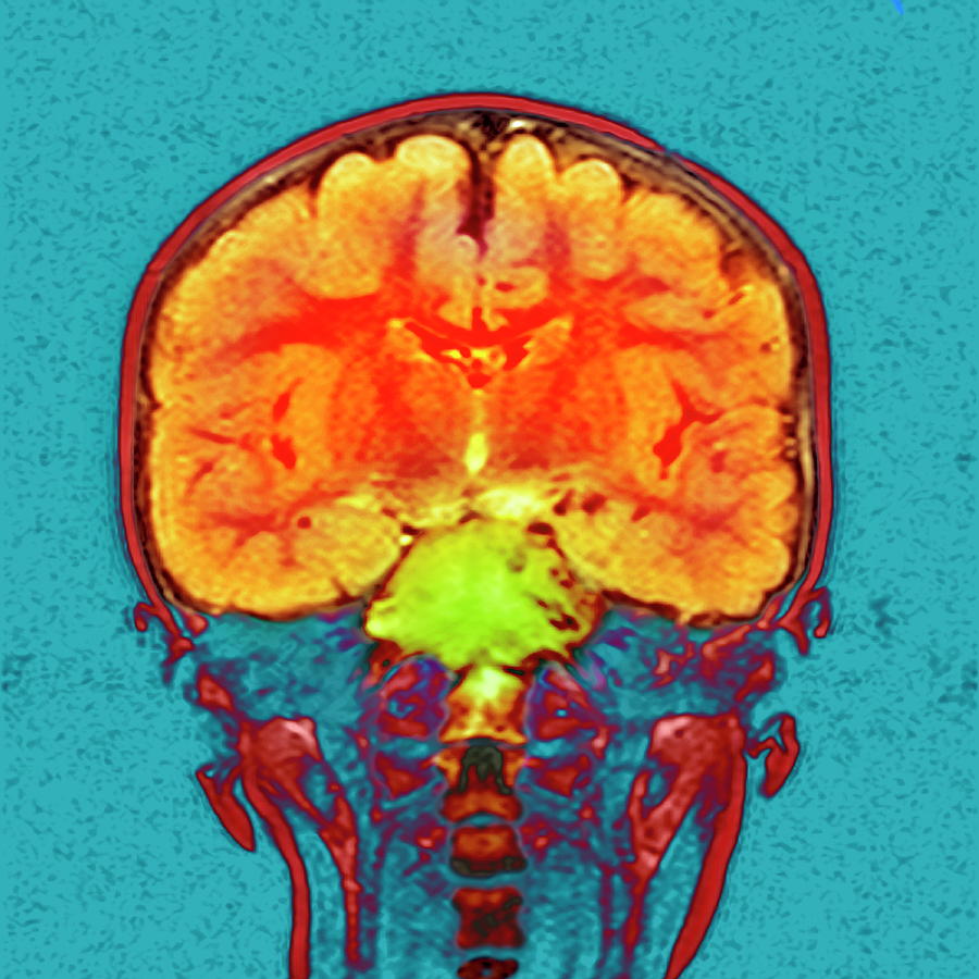 Brain Cancer #2 Photograph by Simon Fraser/newcastle Hospitals Nhs Trust/science Photo Library