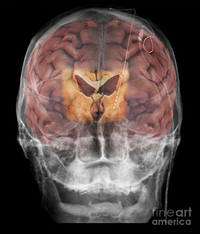 Brain Implants For Parkinsons Disease 2 Photograph By Zephyr Pixels