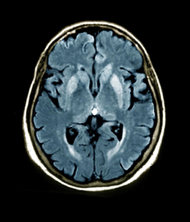 Brain In Creutzfeldt-jakob Disease #2 Photograph by Zephyr