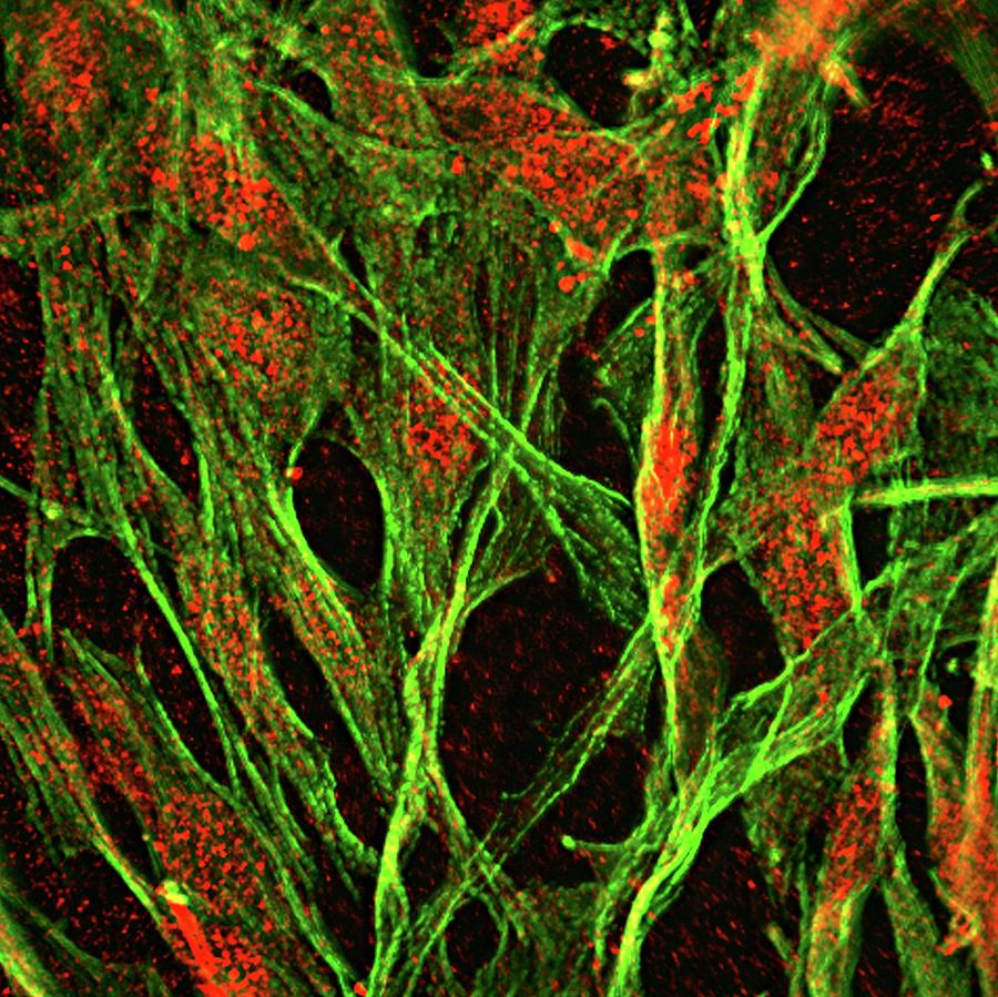 Brain Protein In Cancer Research #2 Photograph by R. Bick, B. Poindexter, Ut Medical School/science Photo Library