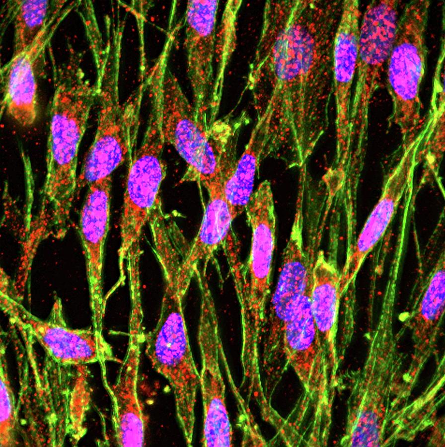 Brain Protein In Parkinsons Research #2 Photograph by R. Bick, B. Poindexter, Ut Medical School/science Photo Library