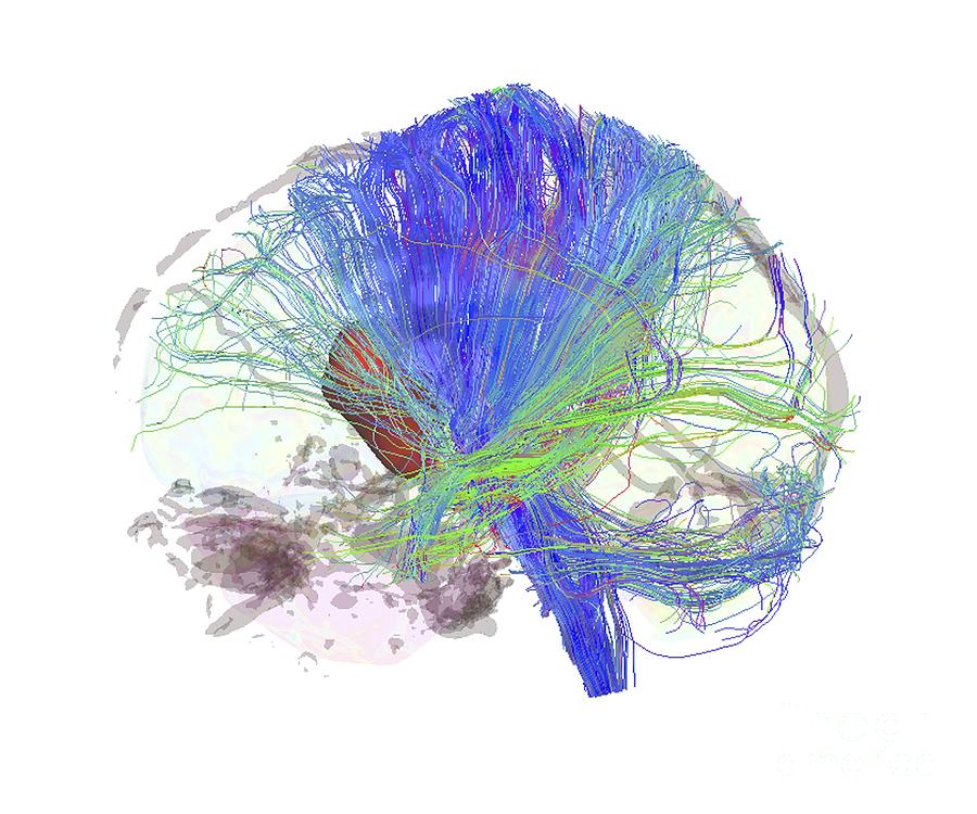 brain-tumour-dti-mri-scan-photograph-by-sherbrooke-connectivity