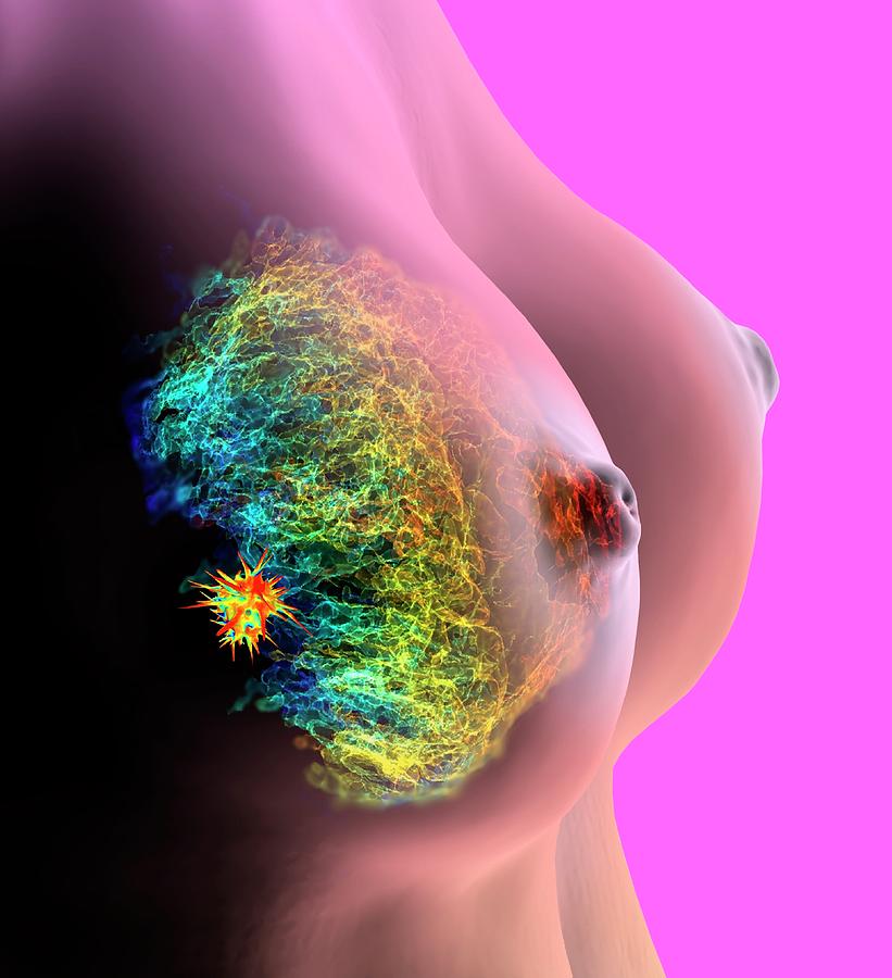Breast Cancer #2 Photograph by K H Fung/science Photo Library