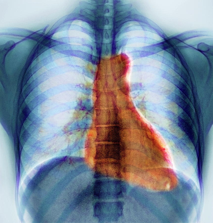 Organ Photograph - Breathing #2 by Pr. M. Brauner/science Photo Library