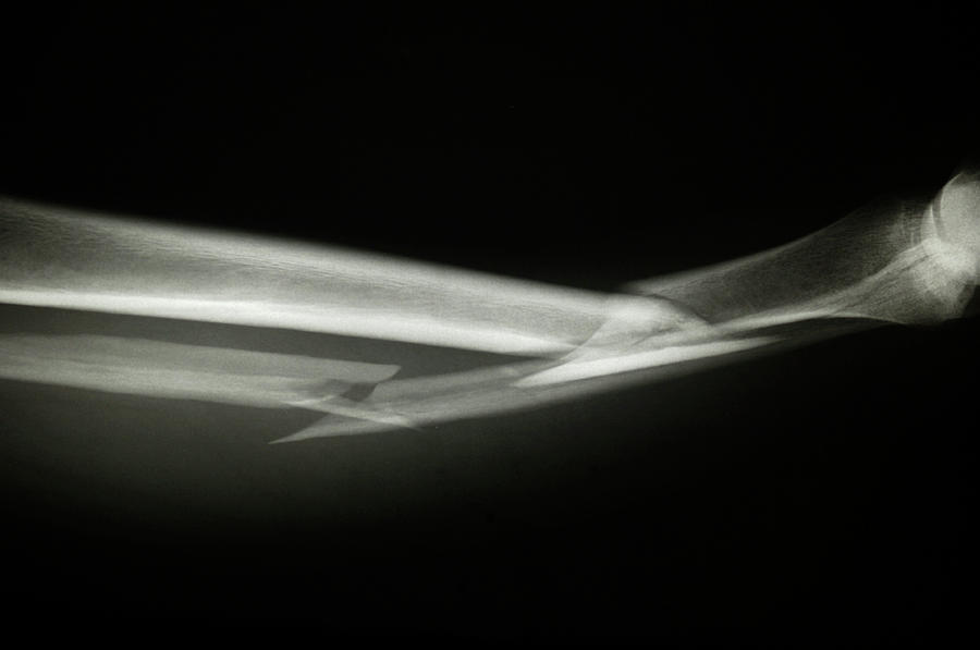 Broken Leg Photograph By Dr P Marazziscience Photo Library