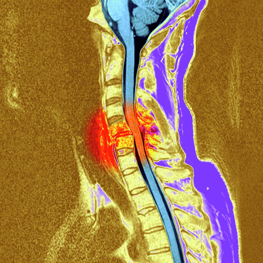 Broken Neck Photograph by Simon Fraser/newcastle Hospitals Nhs Trust