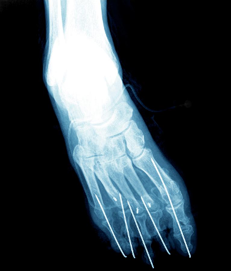 Nobody Photograph - Bunion After Surgery #2 by Zephyr