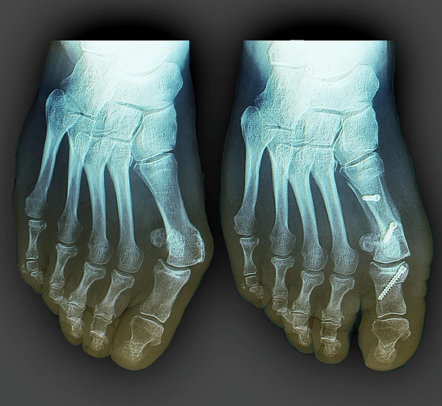 Bunion Surgery Assessment #2 Photograph by Zephyr/science Photo Library