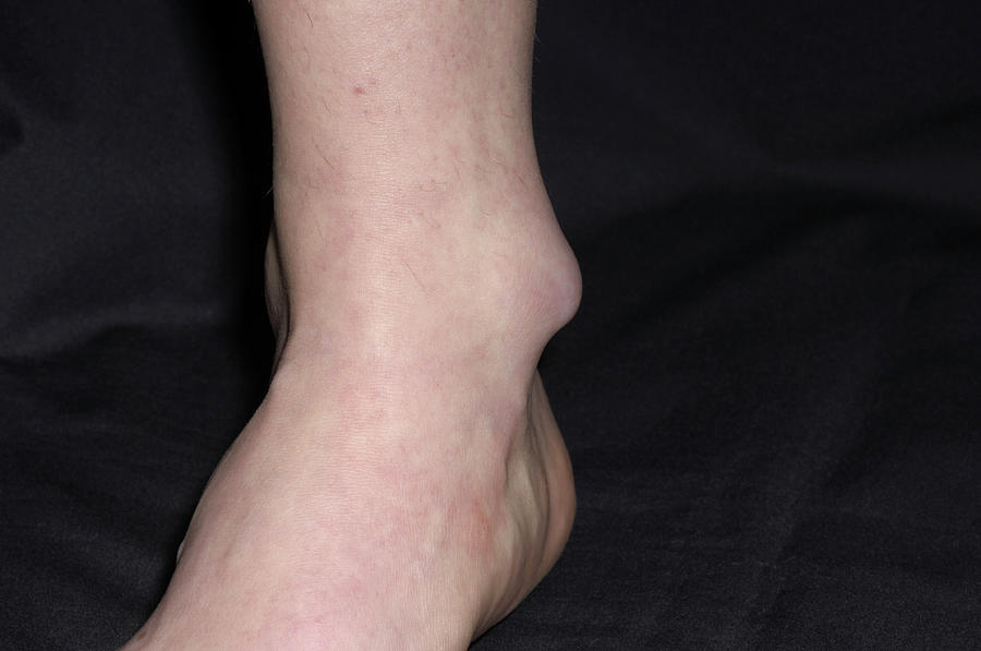 Bursitis Of The Ankle Photograph by Dr P. Marazzi/science Photo Library