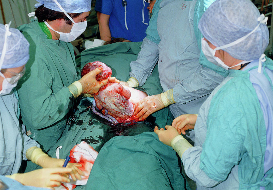 Caesarean Section #2 Photograph by Eddie Lawrence/science Photo Library