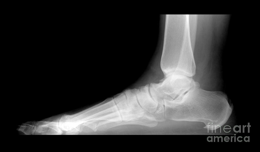 Xray Of Foot Photograph - Calcaneal Spurs, X-ray #2 by Living Art Enterprises