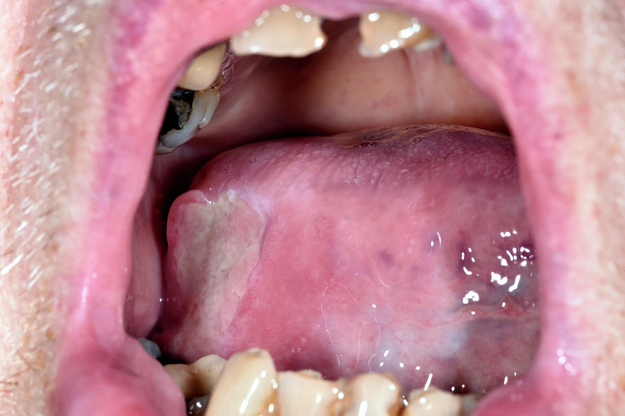 Canker Sore Photograph by Dr P. Marazzi/science Photo Library