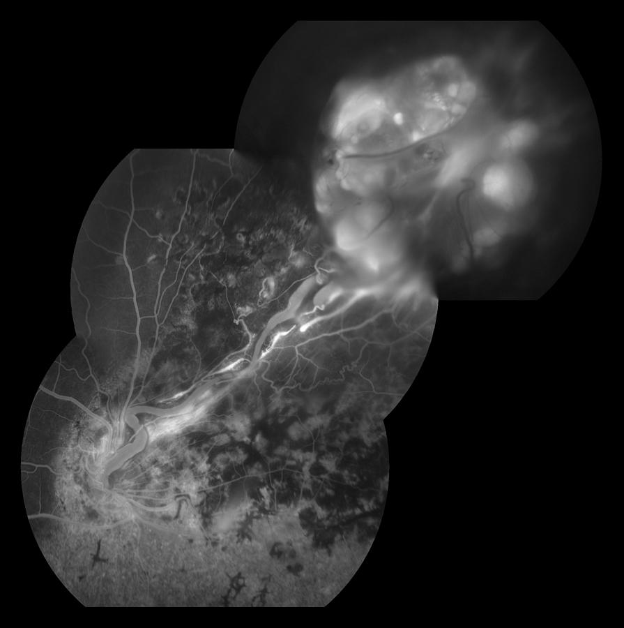 Capillary Hemangioma, Ophthalmic #2 Photograph by Paul Whitten
