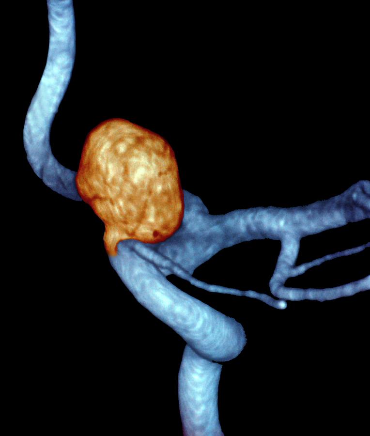 Carotid Aneurysm #2 Photograph by Zephyr/science Photo Library