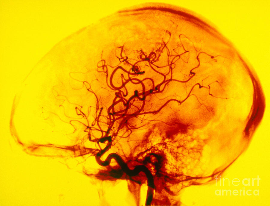 Cerebral Angiogram #2 Photograph by Scott Camazine
