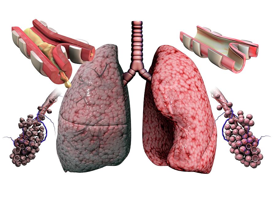 Bronchitis Photograph - Chronic Obstructive Pulmonary Disease #2 by Gunilla Elam/science Photo Library