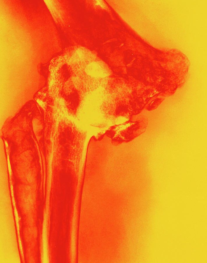 Col Xray Of Rheumatoid Arthritis Of The Elbow Photograph by Medical