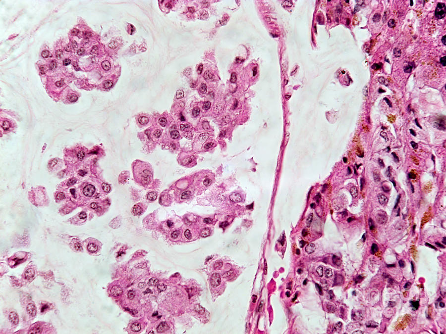 Colloid Liver Tumor, Lm #2 Photograph by Garry DeLong