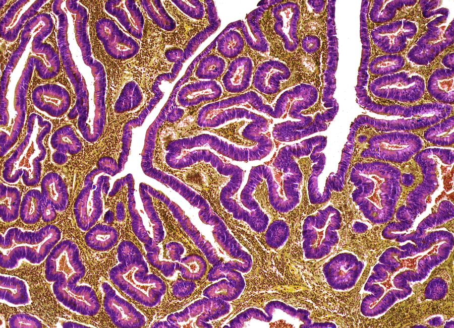 Colon Cancer #2 Photograph by Steve Gschmeissner/science Photo Library