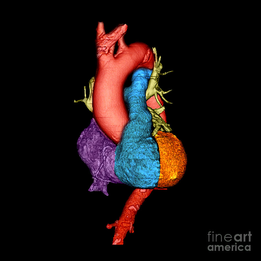 Ct Of Heart Photograph - Color Enhanced 3d Ct Of Heart #2 by Living Art Enterprises