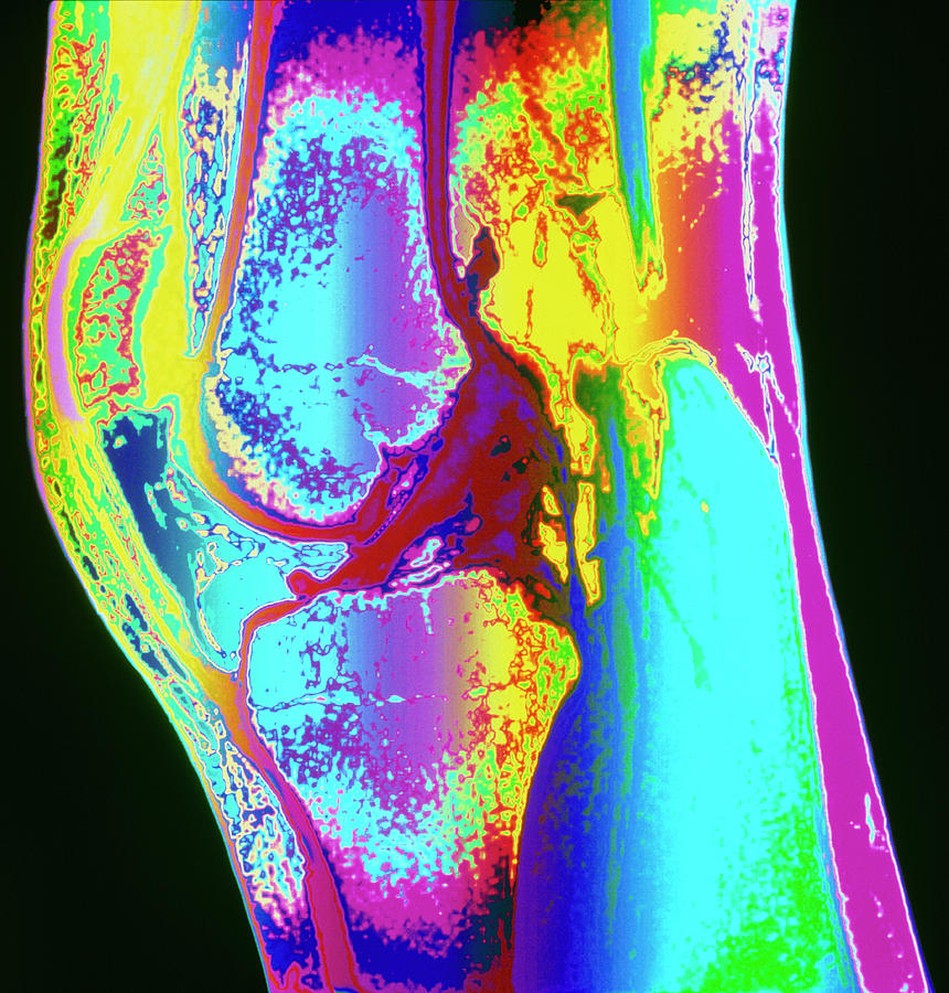 Coloured Mri Of A Section Through A Knee Joint Photograph By Simon Fraserscience Photo Library 6314