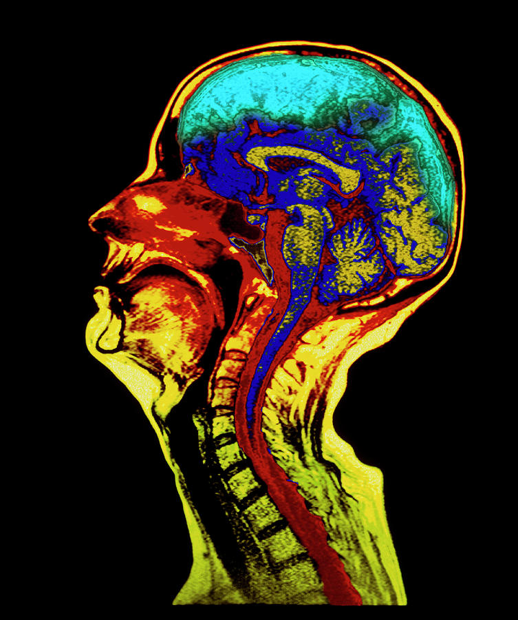 Coloured Mri Scan Of A Brain With Cerebral Atrophy Photograph by Simon ...