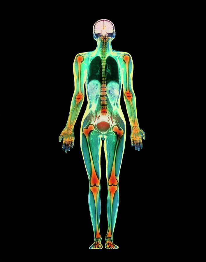 Coloured Mri Scan Of A Whole Human Body (female) #2 Photograph by Simon Fraser/science Photo Library